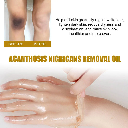 Acanthosis Nigricans Removal Oil, Exfoliating Light Black Brightening And Beauty Skin Oil eprolo